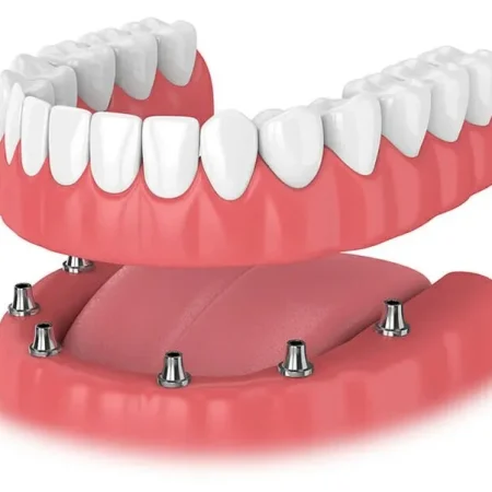 implant denture - Pearly White Dental in Fulham